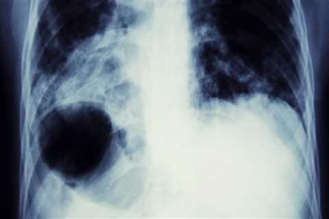 What is asbestos lung cancer?