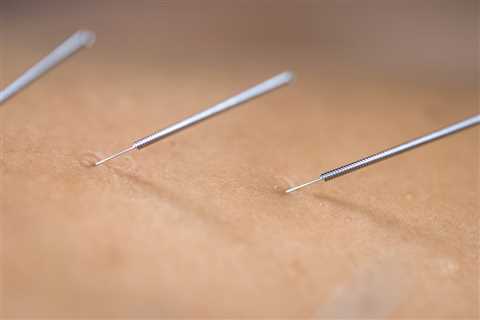 THE BENEFITS OF ACUPUNCTURE FOR CHRONIC PAIN IN THE ELDERLY