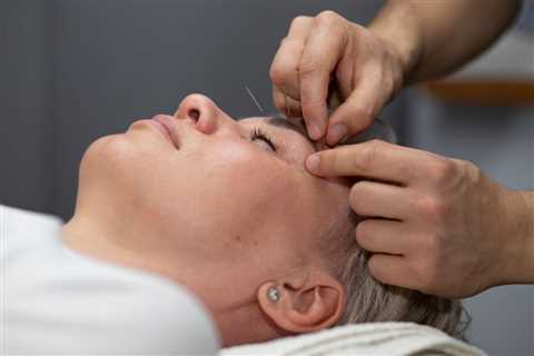 THE BENEFITS OF ACUPUNCTURE FOR MIGRAINE PREVENTION