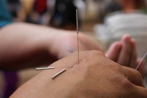 USING ACUPUNCTURE FOR SMARTPHONE ADDICTION RECOVERY